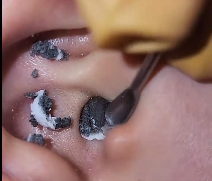 Earwax procedure.