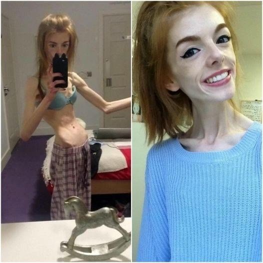 This young woman only ate one piece of bread a day for 5 years